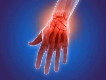 Rheumatoid Arthritis