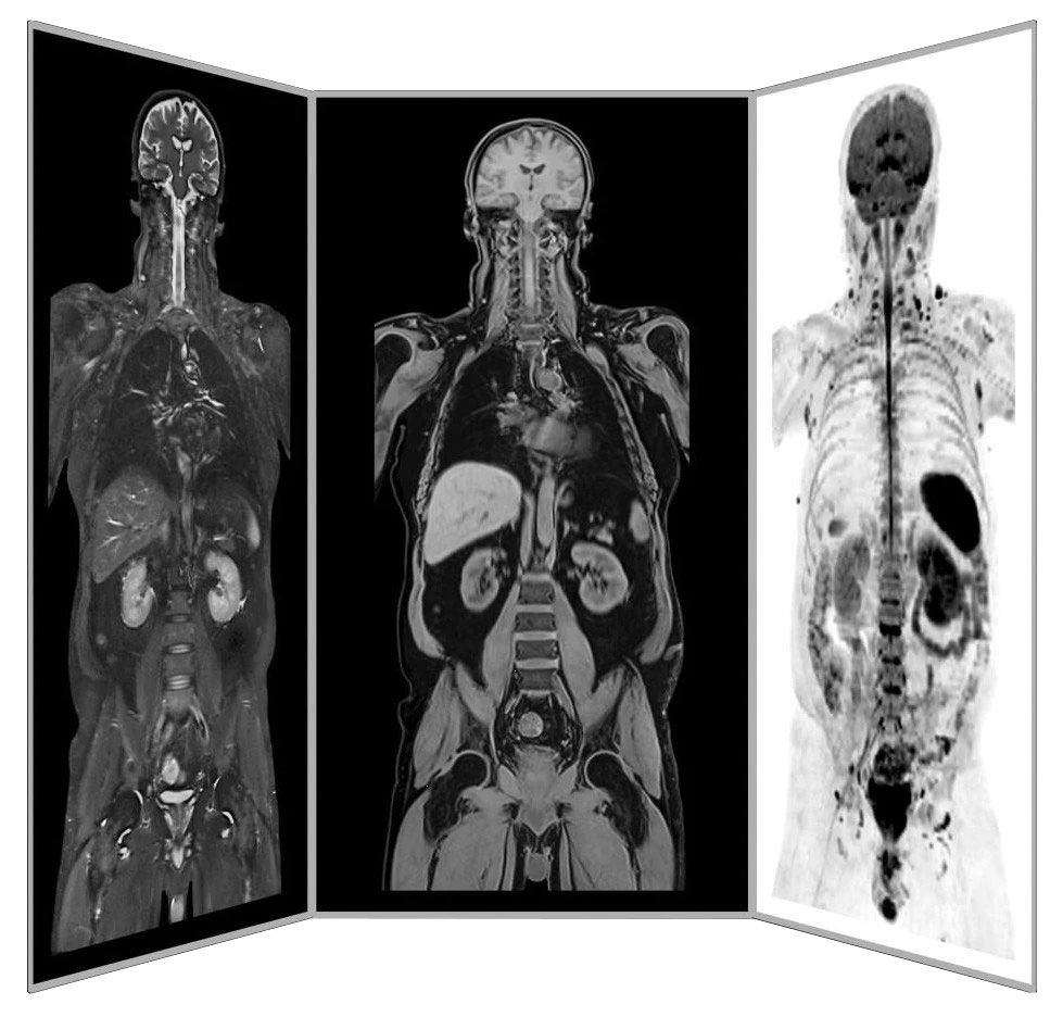 Preventive full body MRI scan ANOVA ANOVA IRM Deutschland Diagnostik MRT Schmerzen Ganzkörper Scan Siemens